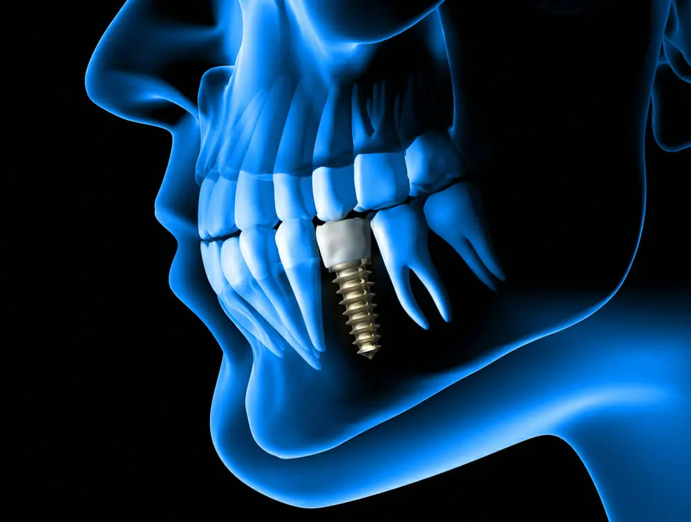 Implantul dentar, soluția optimă în cazul  pierderii unui dinte sau a unei măsele?